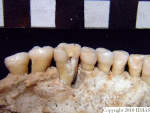 L_V20d5084 A16.31 R827 lR ta dental cavity affecting gum, left maxilla .JPG L_V20d5084 A16.31 R827 lR ta dental cavity affecting gum, left maxilla